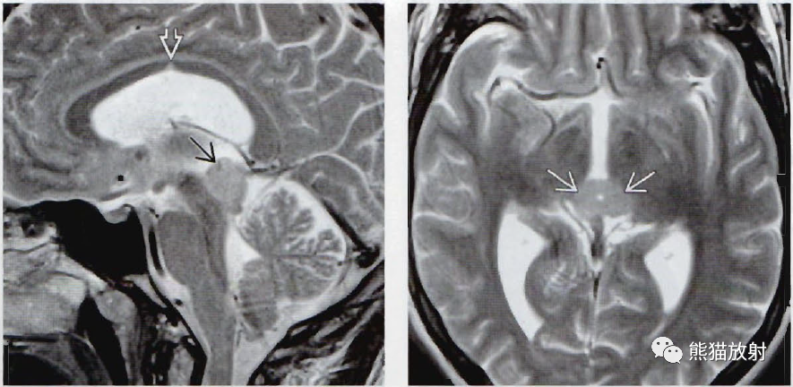 ​中脑导水管狭窄影像诊断要点-5