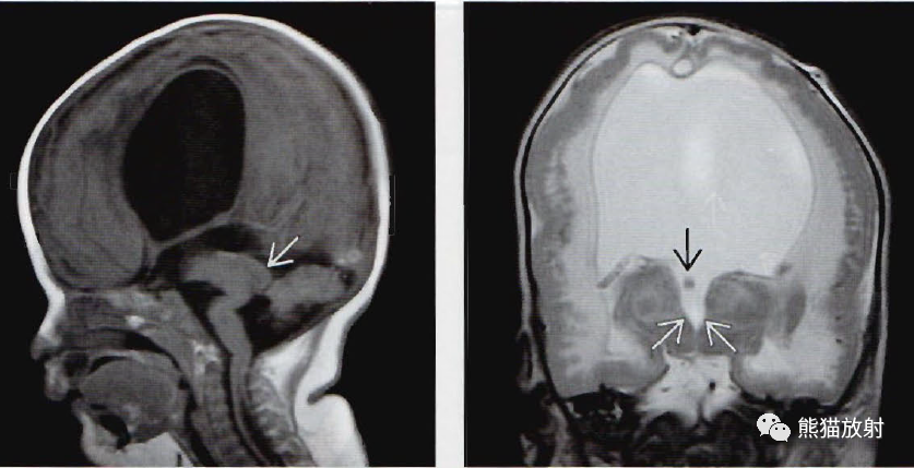 ​中脑导水管狭窄影像诊断要点-4