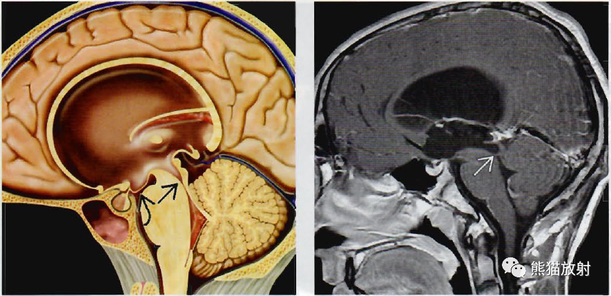 ​中脑导水管狭窄影像诊断要点-1