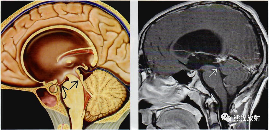 ​中脑导水管狭窄影像诊断要点