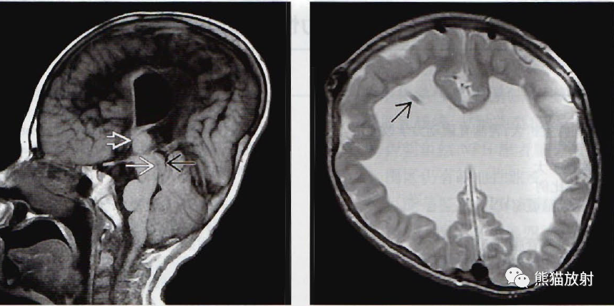 ​中脑导水管狭窄影像诊断要点-3