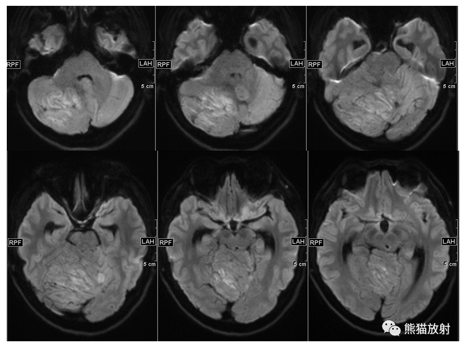 【PPT】小脑发育不良性神经节细胞瘤 VS 成人型髓母细胞瘤-6