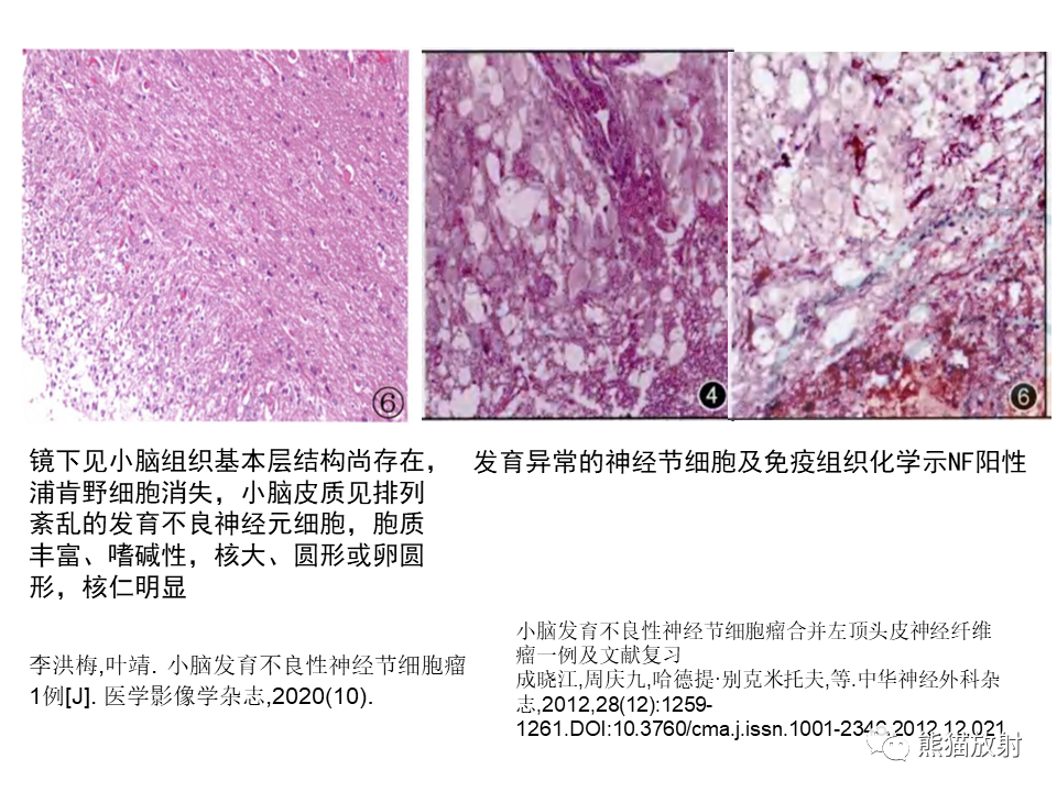 【PPT】小脑发育不良性神经节细胞瘤 VS 成人型髓母细胞瘤-31