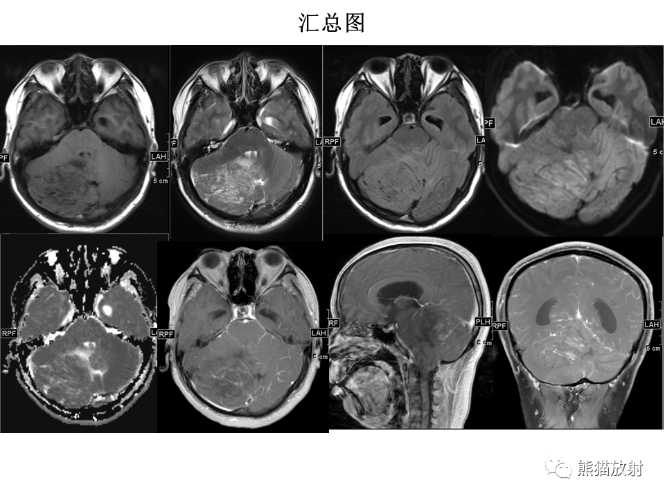 【PPT】小脑发育不良性神经节细胞瘤 VS 成人型髓母细胞瘤-13
