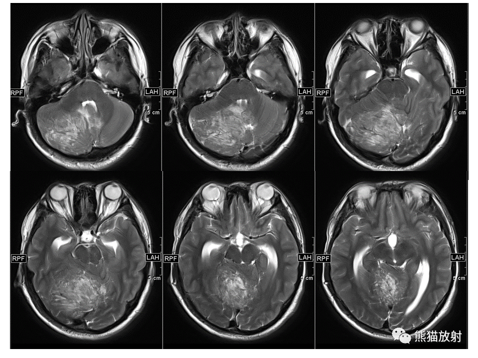 【PPT】小脑发育不良性神经节细胞瘤 VS 成人型髓母细胞瘤-4