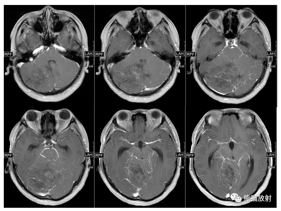 【PPT】小脑发育不良性神经节细胞瘤 VS 成人型髓母细胞瘤-10