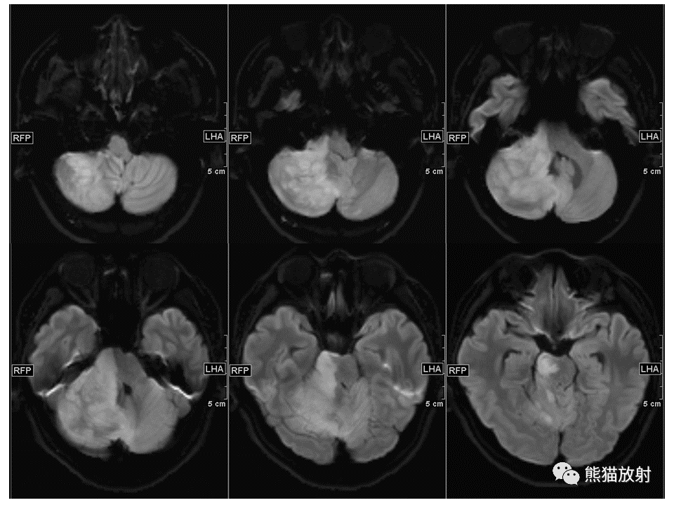 【PPT】小脑发育不良性神经节细胞瘤 VS 成人型髓母细胞瘤-19