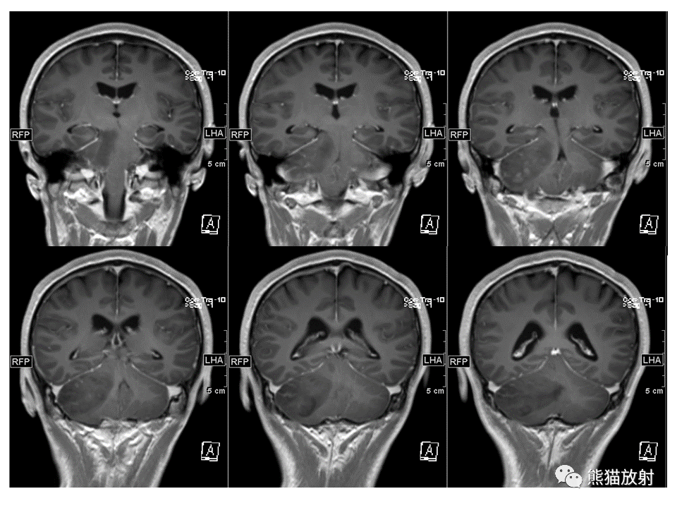 【PPT】小脑发育不良性神经节细胞瘤 VS 成人型髓母细胞瘤-24