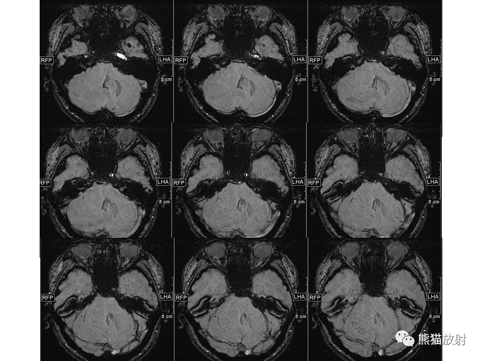 【PPT】小脑发育不良性神经节细胞瘤 VS 成人型髓母细胞瘤-21