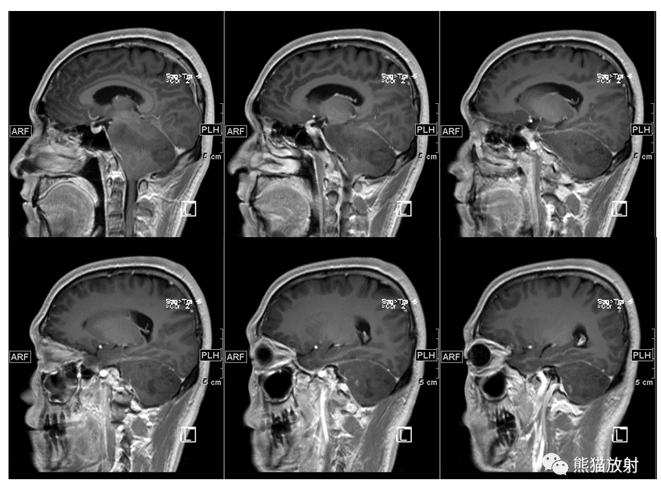 【PPT】小脑发育不良性神经节细胞瘤 VS 成人型髓母细胞瘤-25