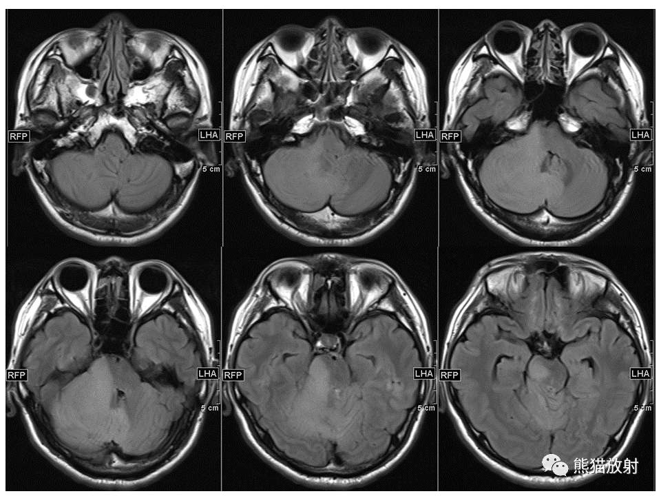 【PPT】小脑发育不良性神经节细胞瘤 VS 成人型髓母细胞瘤-18