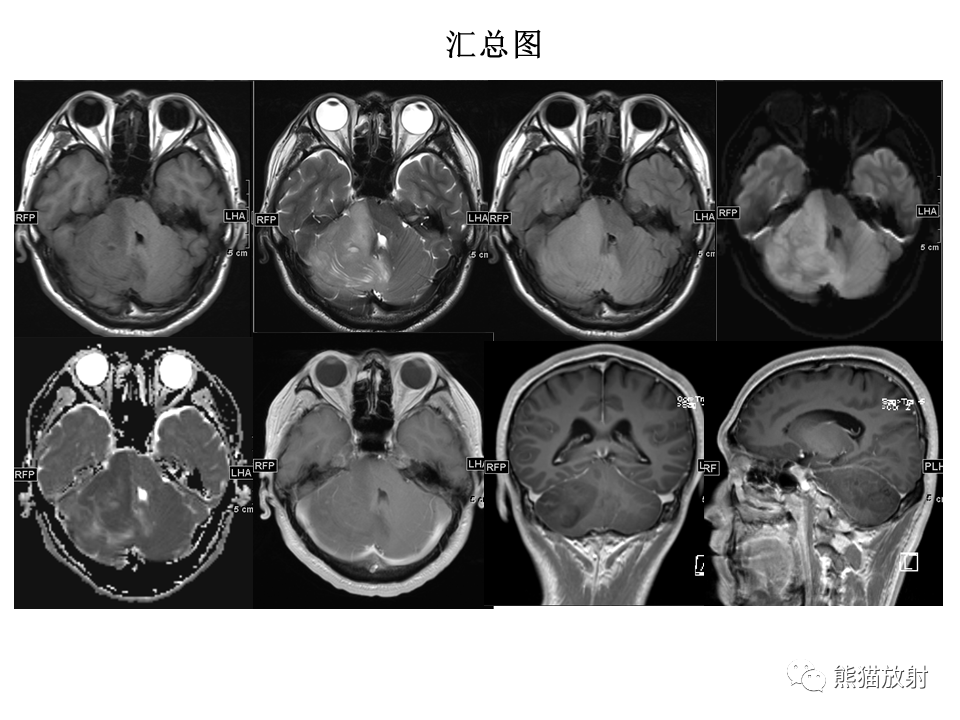 【PPT】小脑发育不良性神经节细胞瘤 VS 成人型髓母细胞瘤-26