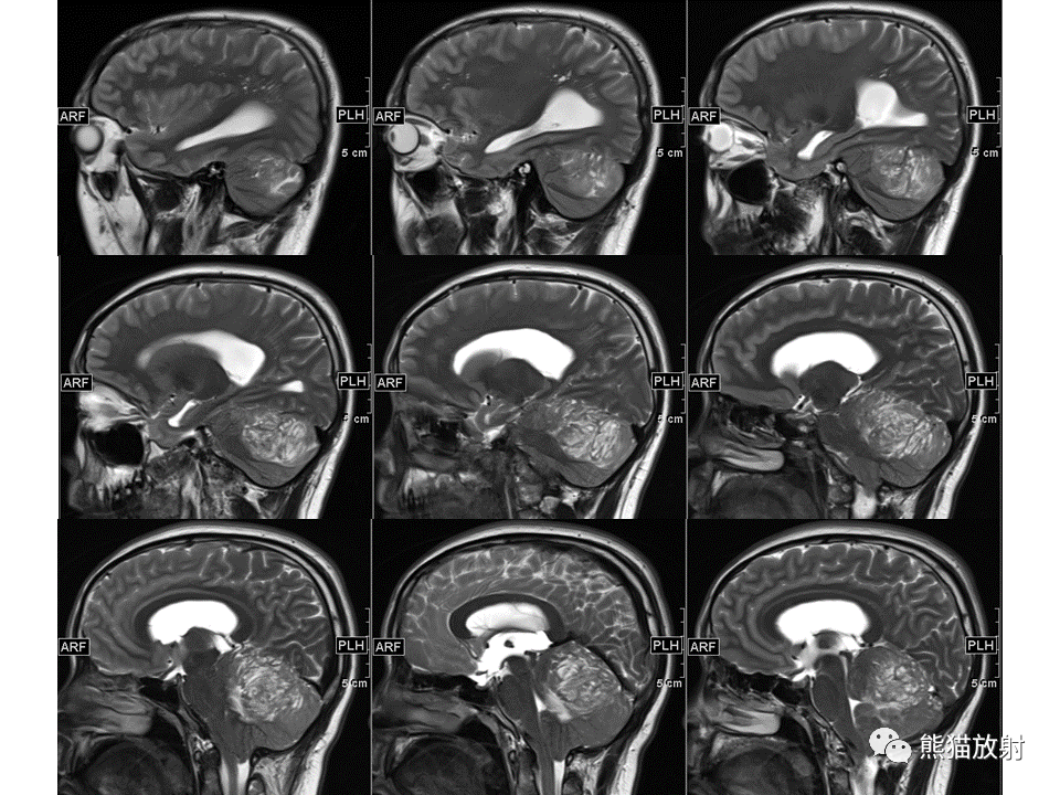 【PPT】小脑发育不良性神经节细胞瘤 VS 成人型髓母细胞瘤-2