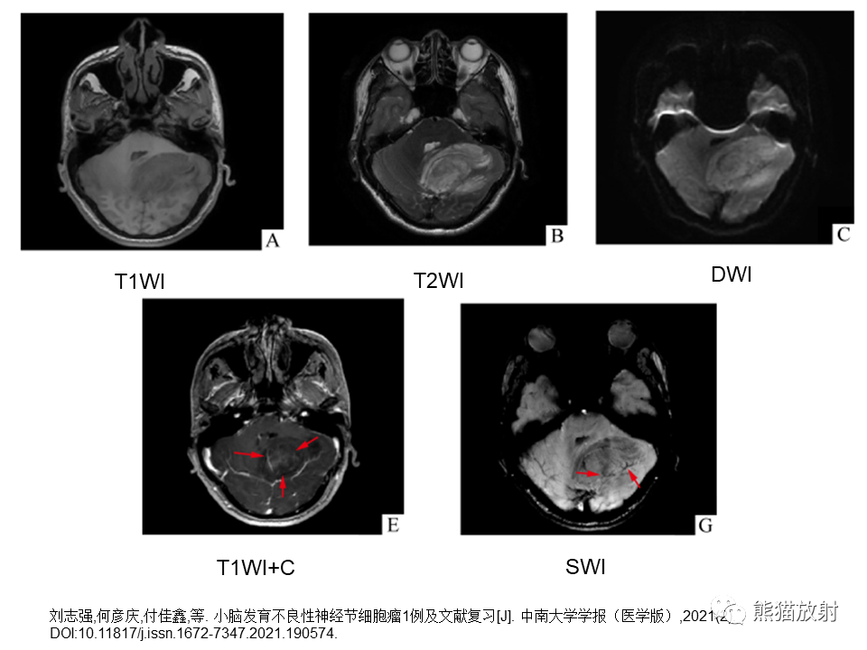 【PPT】小脑发育不良性神经节细胞瘤 VS 成人型髓母细胞瘤-34
