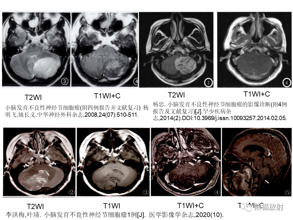 【PPT】小脑发育不良性神经节细胞瘤 VS 成人型髓母细胞瘤-33