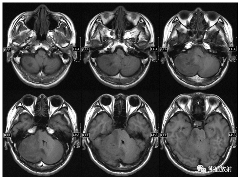 【PPT】小脑发育不良性神经节细胞瘤 VS 成人型髓母细胞瘤-16