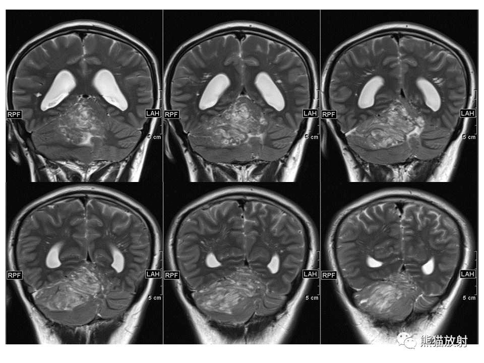 【PPT】小脑发育不良性神经节细胞瘤 VS 成人型髓母细胞瘤-9