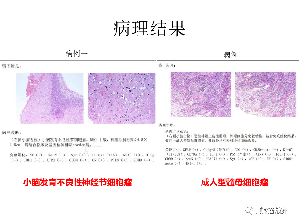 【PPT】小脑发育不良性神经节细胞瘤 VS 成人型髓母细胞瘤-28