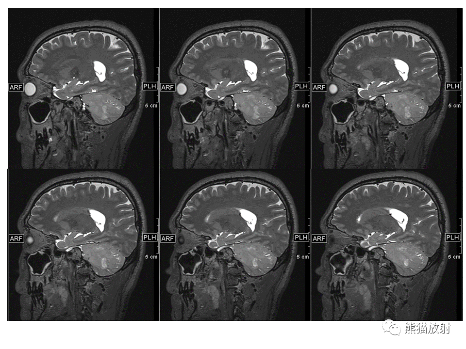 【PPT】小脑发育不良性神经节细胞瘤 VS 成人型髓母细胞瘤-22