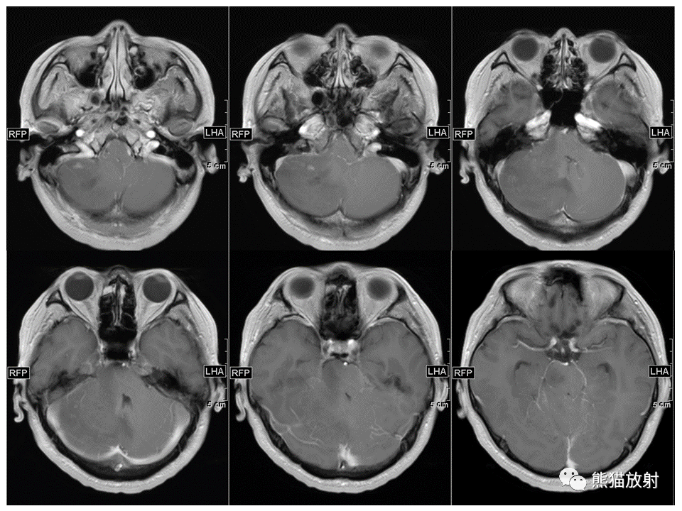 【PPT】小脑发育不良性神经节细胞瘤 VS 成人型髓母细胞瘤-23