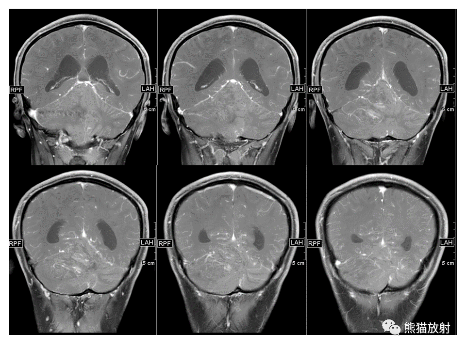 【PPT】小脑发育不良性神经节细胞瘤 VS 成人型髓母细胞瘤-12