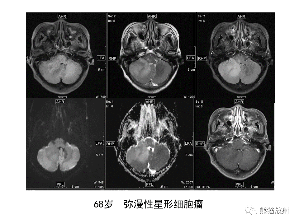 【PPT】小脑发育不良性神经节细胞瘤 VS 成人型髓母细胞瘤-39