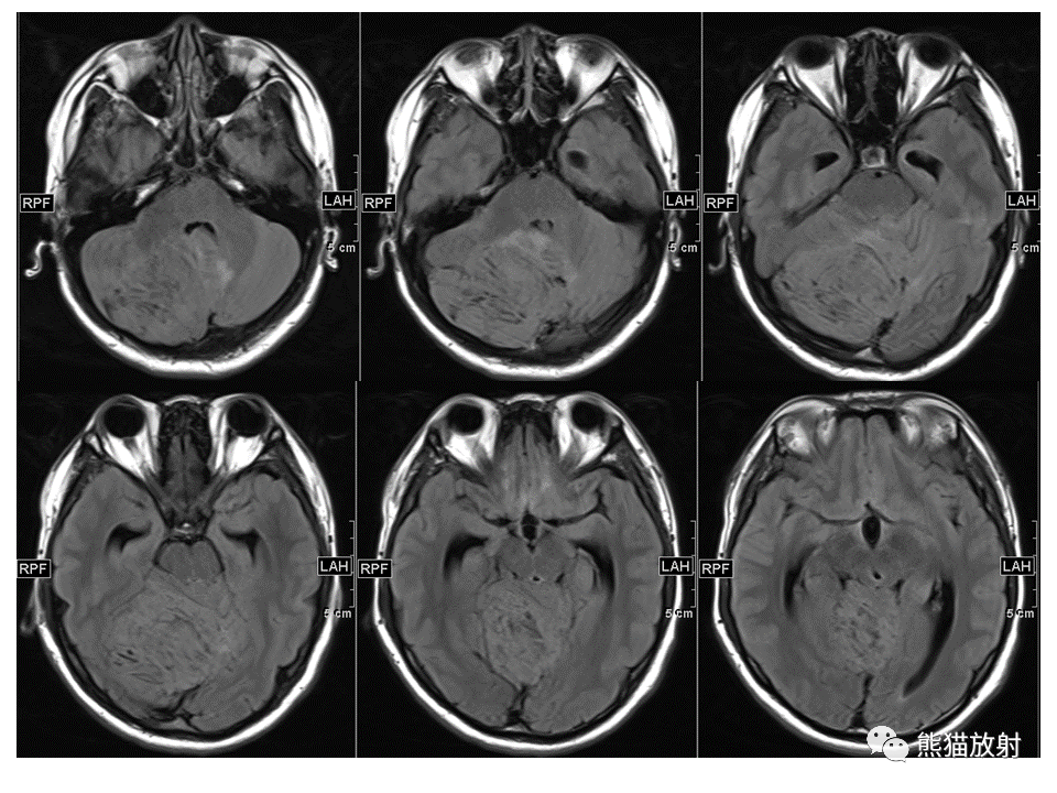 【PPT】小脑发育不良性神经节细胞瘤 VS 成人型髓母细胞瘤-5