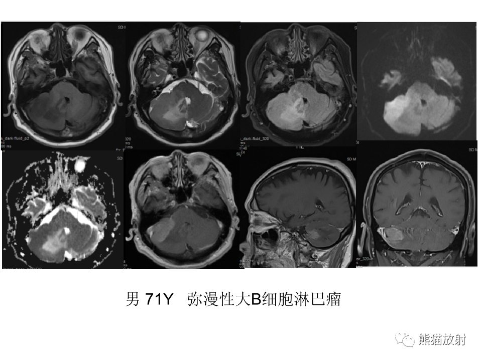 【PPT】小脑发育不良性神经节细胞瘤 VS 成人型髓母细胞瘤-43