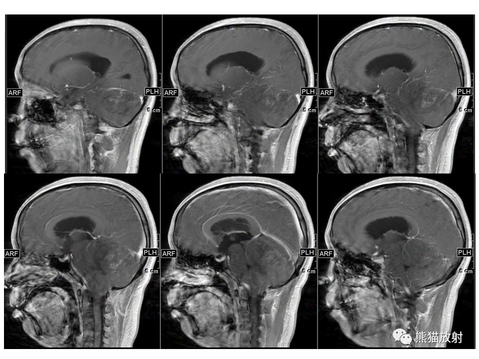 【PPT】小脑发育不良性神经节细胞瘤 VS 成人型髓母细胞瘤-11