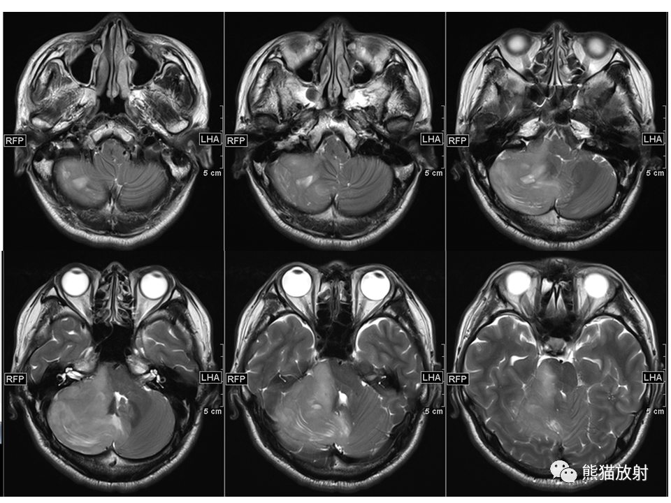 【PPT】小脑发育不良性神经节细胞瘤 VS 成人型髓母细胞瘤-17