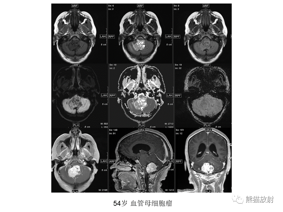 【PPT】小脑发育不良性神经节细胞瘤 VS 成人型髓母细胞瘤-41
