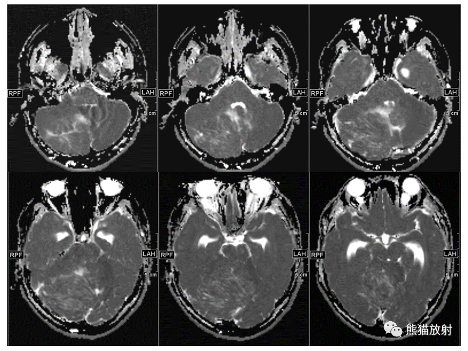 【PPT】小脑发育不良性神经节细胞瘤 VS 成人型髓母细胞瘤-1