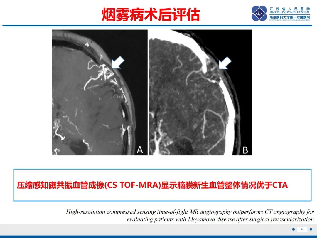 【PPT】烟雾病和烟雾综合征血管重建术后影像评估-36