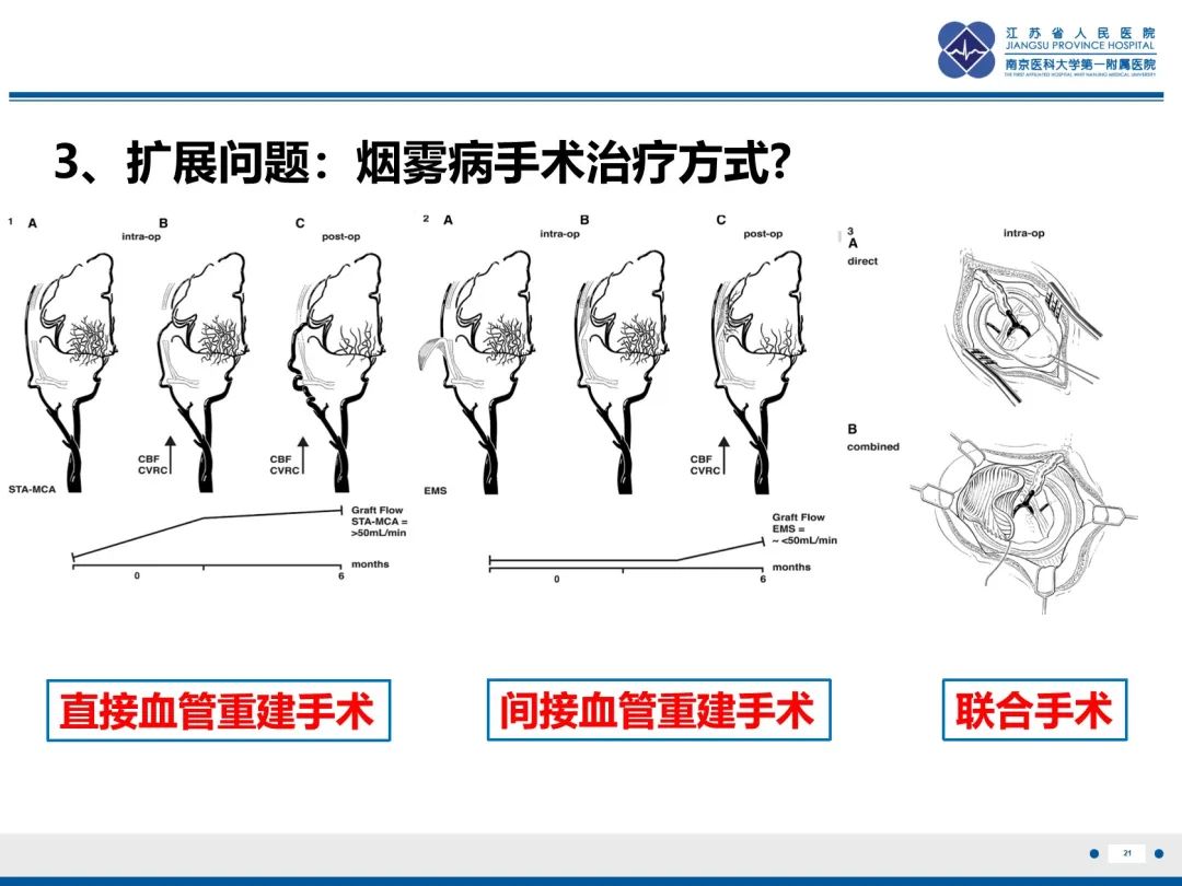 【PPT】烟雾病和烟雾综合征血管重建术后影像评估-22