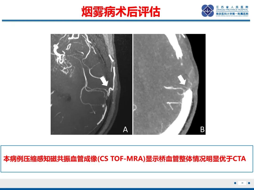 【PPT】烟雾病和烟雾综合征血管重建术后影像评估-35