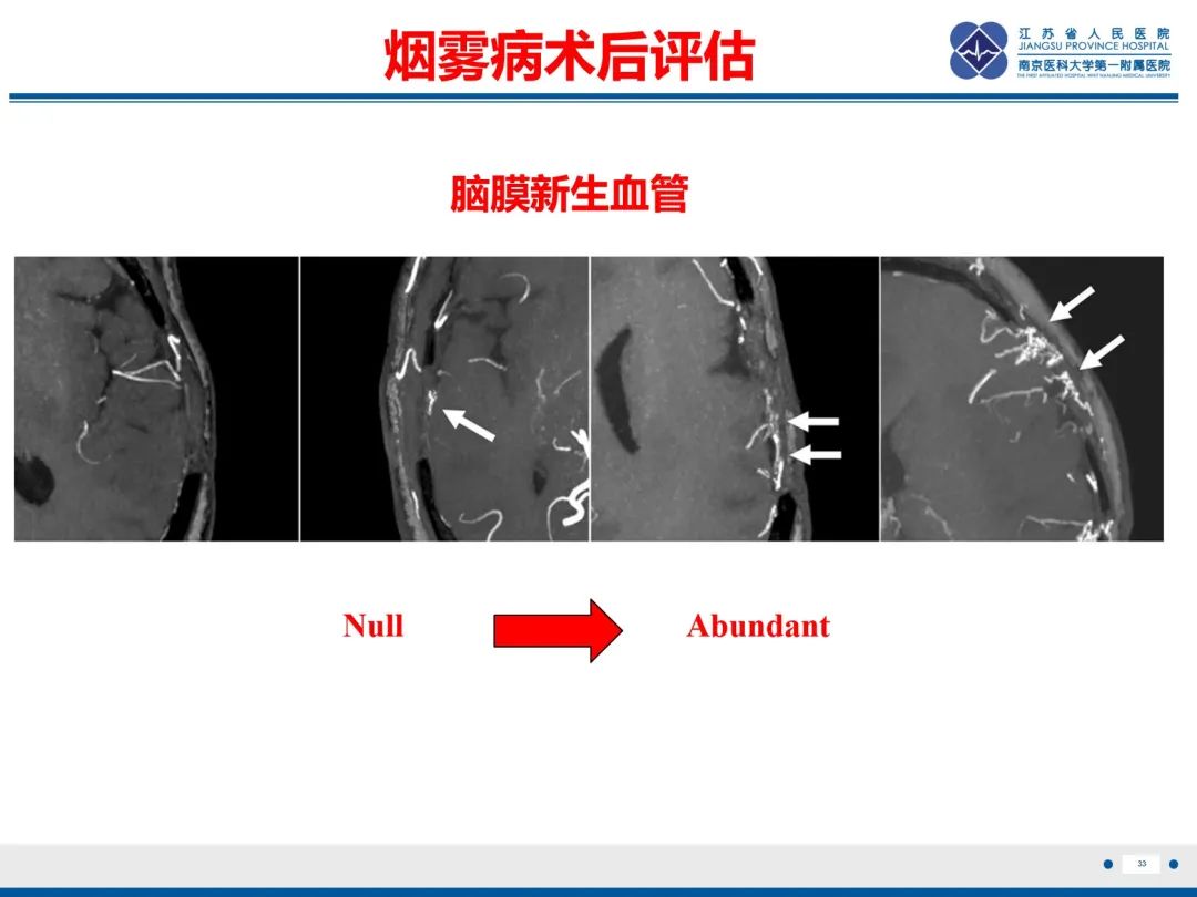 【PPT】烟雾病和烟雾综合征血管重建术后影像评估-34