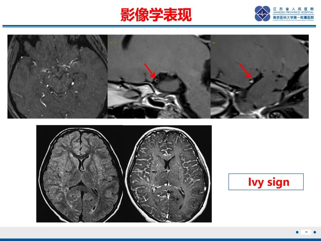 【PPT】烟雾病和烟雾综合征血管重建术后影像评估-19