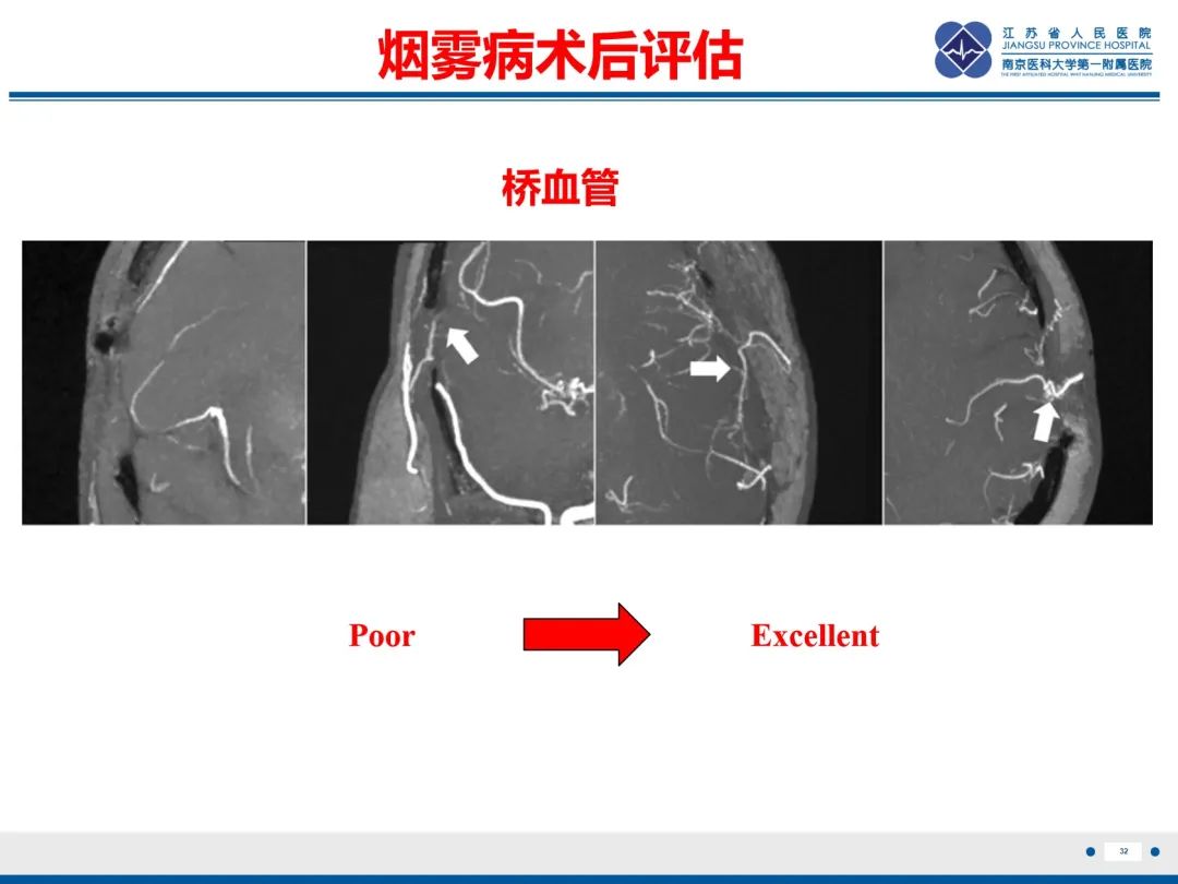 【PPT】烟雾病和烟雾综合征血管重建术后影像评估-33