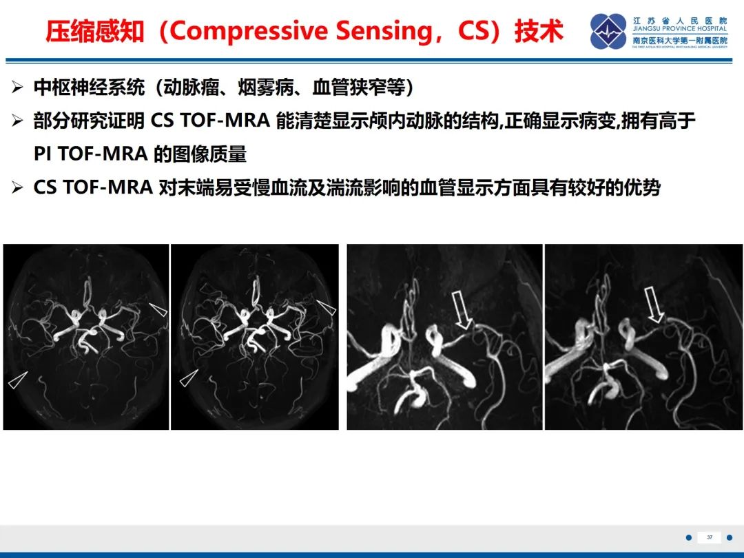 【PPT】烟雾病和烟雾综合征血管重建术后影像评估-38