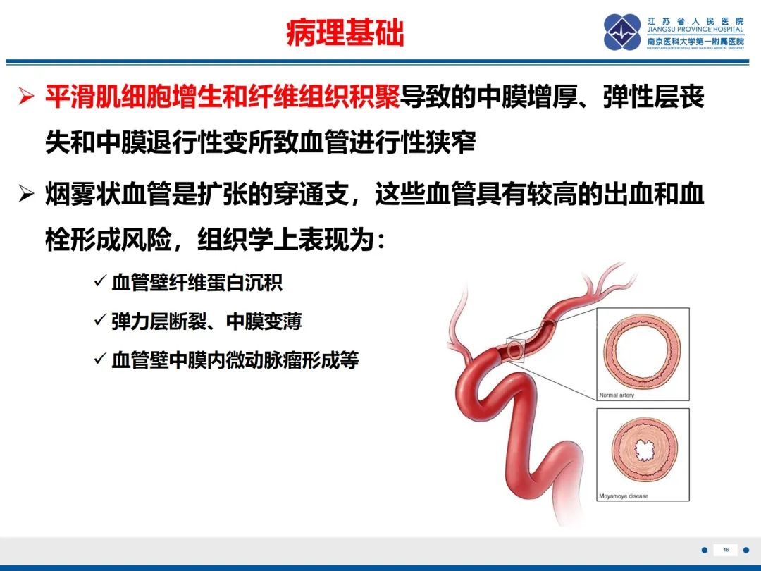 【PPT】烟雾病和烟雾综合征血管重建术后影像评估-17