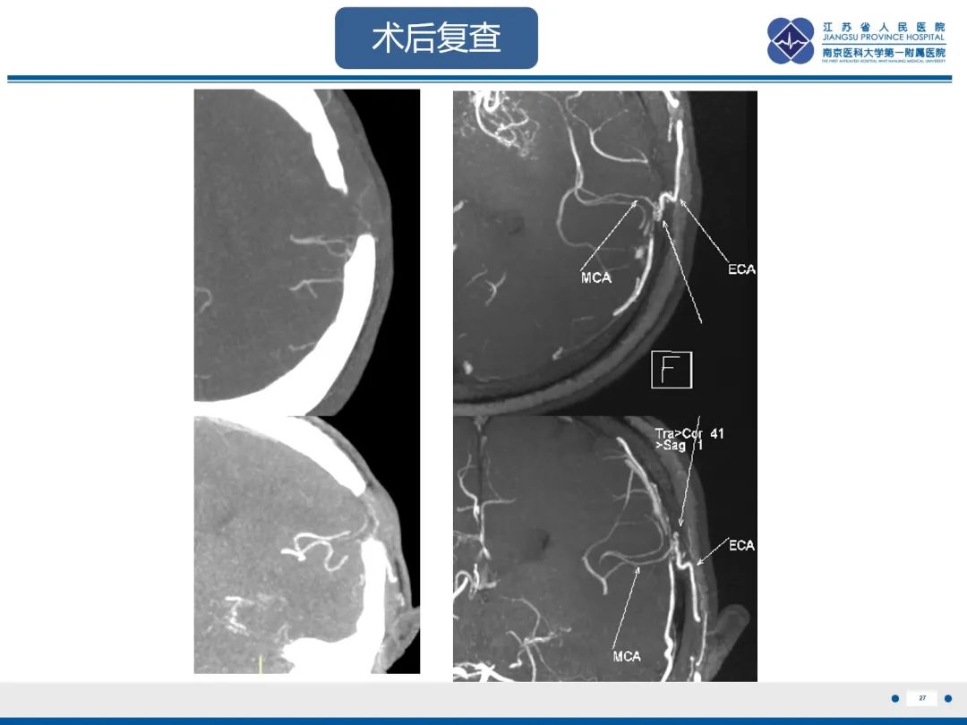 【PPT】烟雾病和烟雾综合征血管重建术后影像评估-28