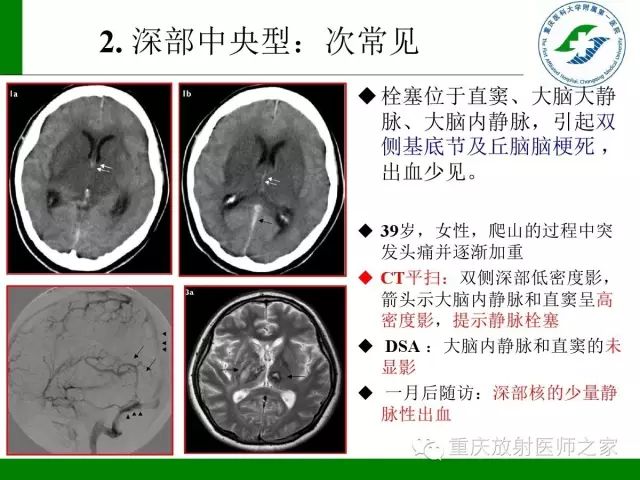 【PPT】脑静脉解剖及相关疾病影像学诊断-24