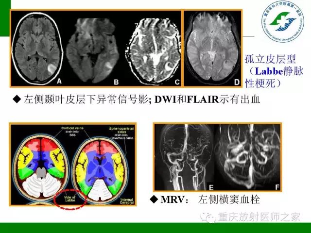 【PPT】脑静脉解剖及相关疾病影像学诊断-32