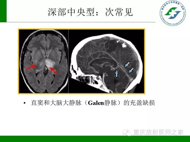 【PPT】脑静脉解剖及相关疾病影像学诊断-25