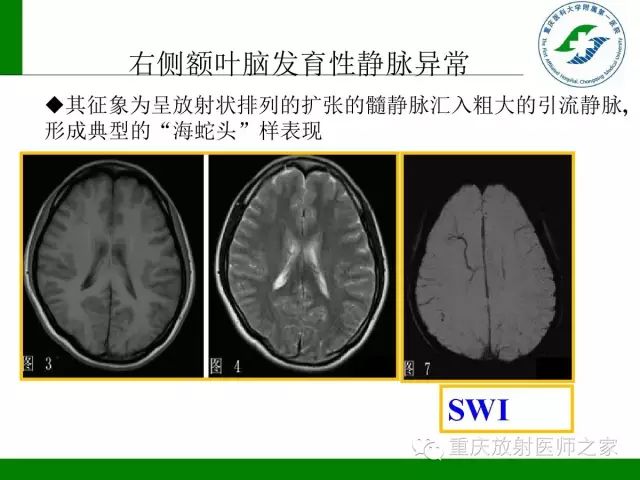 【PPT】脑静脉解剖及相关疾病影像学诊断-51