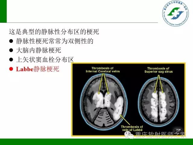 【PPT】脑静脉解剖及相关疾病影像学诊断-21