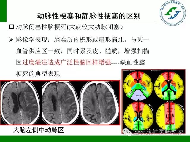 【PPT】脑静脉解剖及相关疾病影像学诊断-65