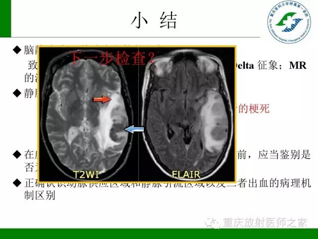 【PPT】脑静脉解剖及相关疾病影像学诊断-68