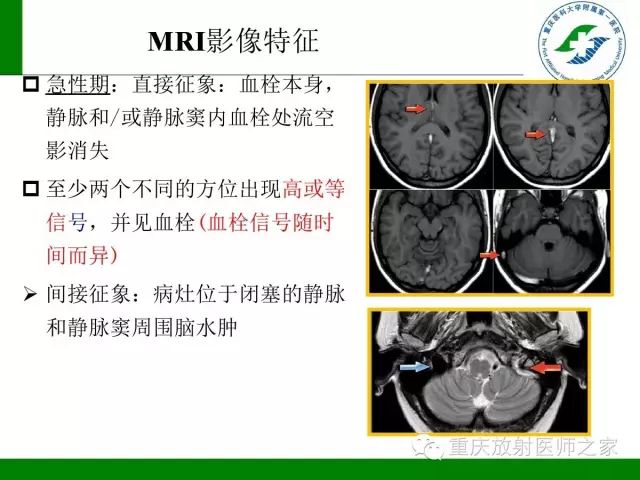 【PPT】脑静脉解剖及相关疾病影像学诊断-36