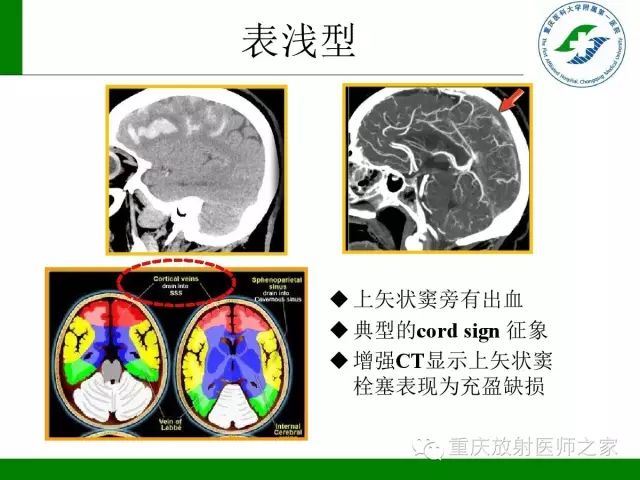【PPT】脑静脉解剖及相关疾病影像学诊断-23